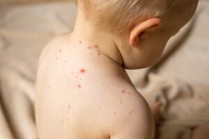 U Banjaluci proglašena epidemija morbila