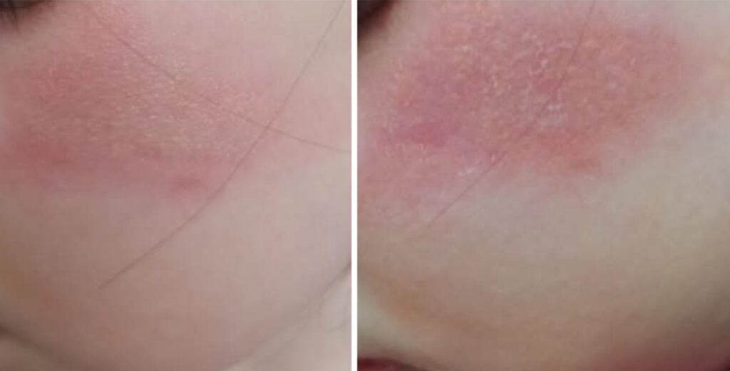 Nakon prijava dermatitisa kod djece, u roditeljskoj grupi planule skandalozne optužbe žena iz vrtića: “Ostavljate djecu u vrtiću 9-10 sati, sram vas bilo”